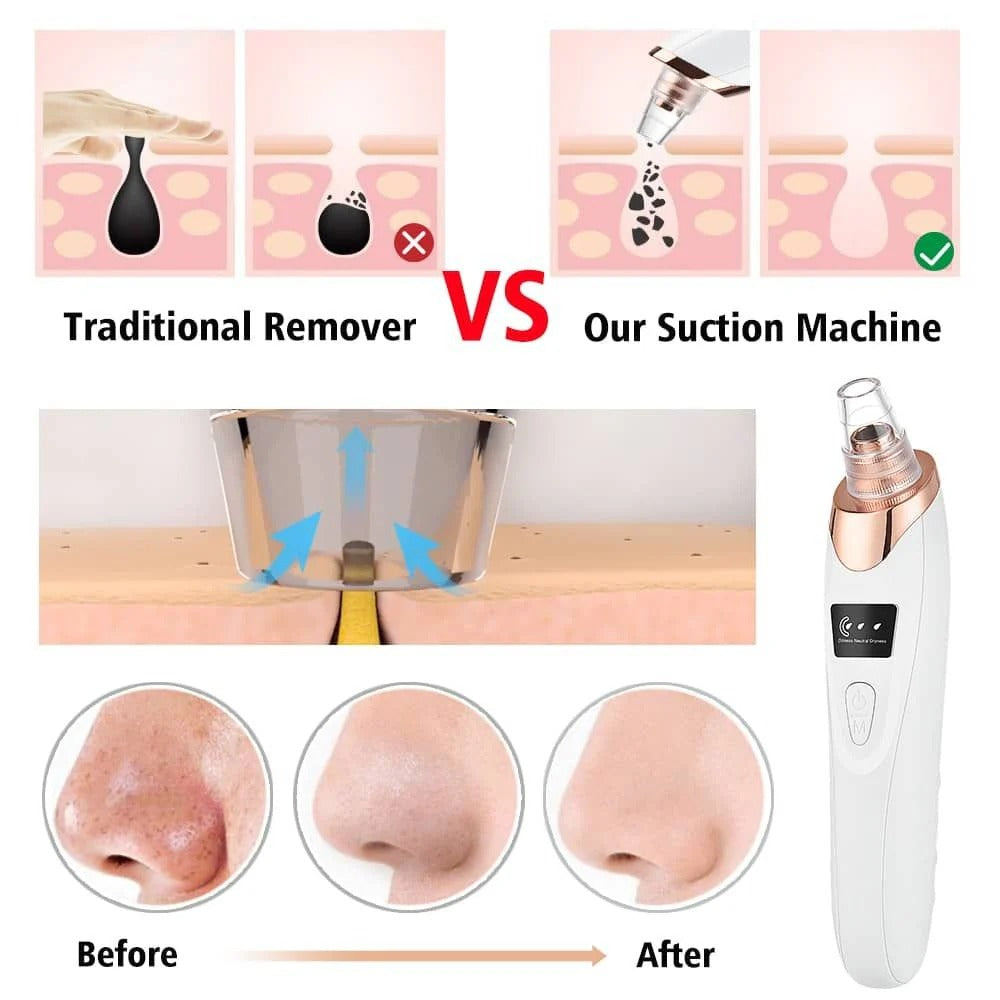 Blackhead Remover Vacuum – Deep Pore Cleaner & Acne Suction Tool for Clear Skin